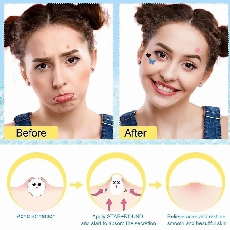 Acne Pimple Patch Stiker Penghilang Jerawat Skin Repair Bentuk Unik — 3